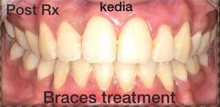 bracetreatment-2