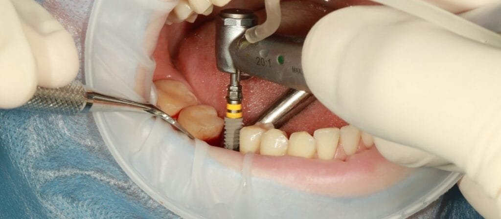 dental implant surgery
