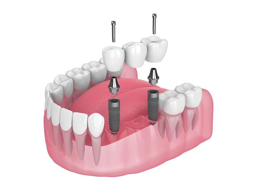 dental implant